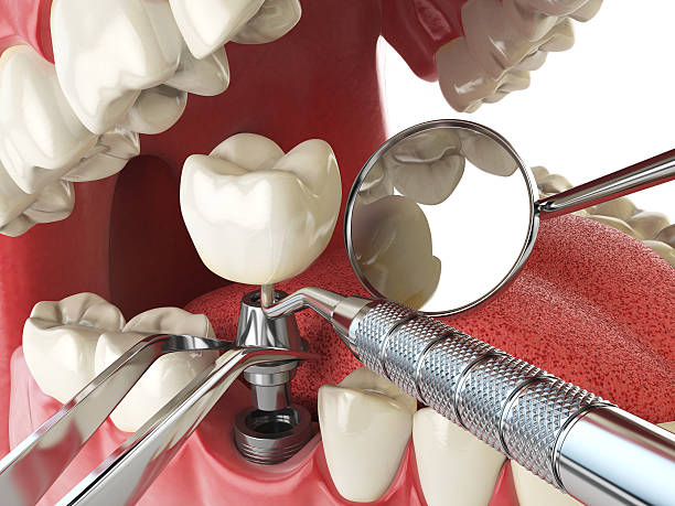 Best Emergency Dental Extractions in Live Oak, CA